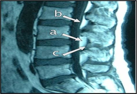 MRI of lumbar spine showing epidural space. (102) (a) Section through ...