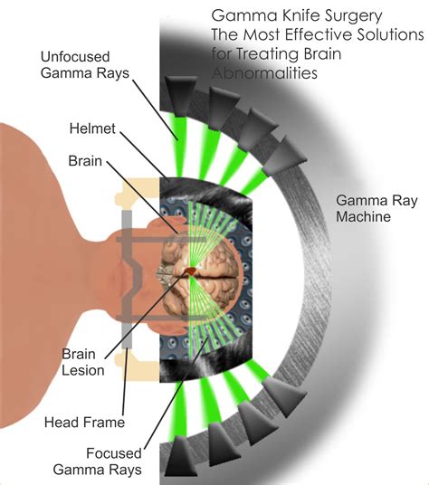 Pin on Gamma Knife Surgery in India