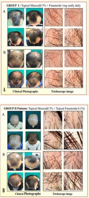 Topical Finasteride - The Belgravia Centre