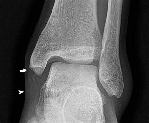 Medial malleolus avulsion fracture - nationalvere