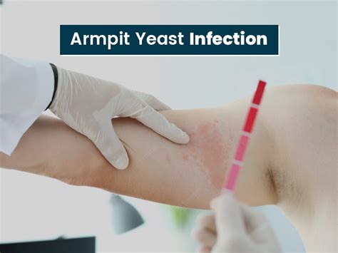 Can Yeast Infection Occur On Armpits? Symptoms, Causes And Prevention Tips You Should Know ...