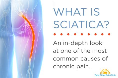 What is Sciatica? | Twin Cities Pain Clinic