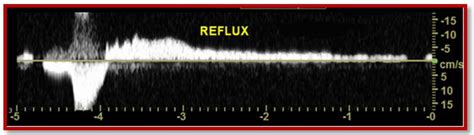 Tips for Obtaining Accurate Venous Reflux Cardioserv