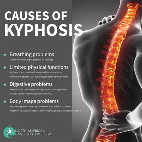 Causes of Kyphosis... | Digestion problems, Gastric problem ...