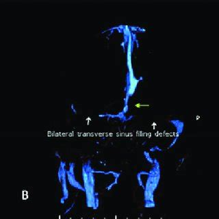 Follow-up CT scan images. A Single-slice axial image of plain CT scan... | Download Scientific ...