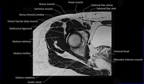 MRI Anatomy of Hip Joint | Free MRI Axial Hip Anatomy