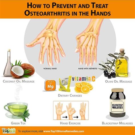 How to Prevent and Treat Osteoarthritis in the Hands | Top 10 Home Remedies | Osteoarthritis ...