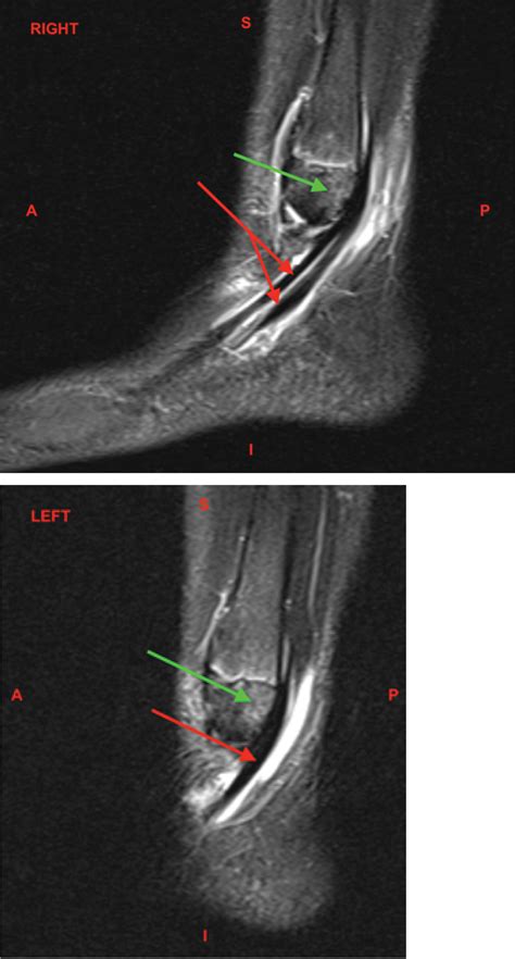 Bilateral Peroneal Tendon Subluxation of an Adolescent Female with MRI Correlations