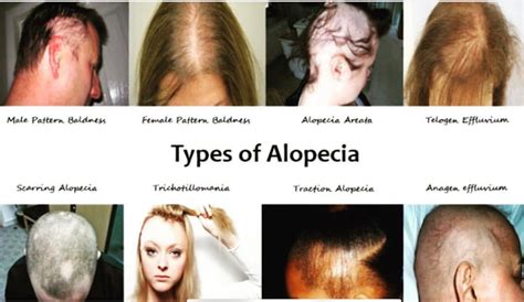 The Different Types of Alopecia Hair Loss