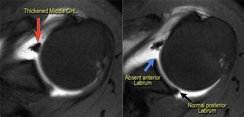 Shoulder Anatomy and Variants on MRI (2022)