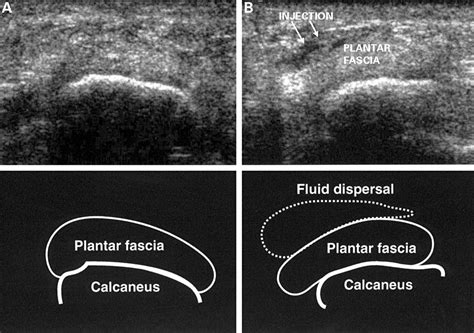 Ultrasound guided injection of plantar fasciitis | Annals of the ...