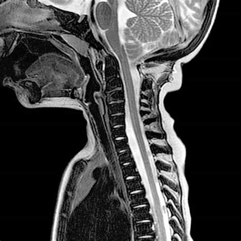 Osteopetrosis | Radiology Key