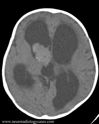 Dr Balaji Anvekar FRCR: Choroid Plexus Papilloma MRI