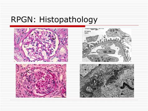 PPT - Anti-Glomerular Basement Membrane Disease PowerPoint Presentation - ID:3303444