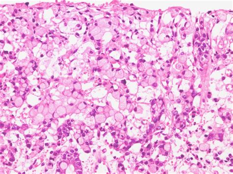 Figure1. Gastric signet-ring cell carcinoma, admixed with a ...