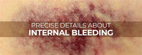 Internal Bleeding: Symptoms, Causes, And TreatmentMarham