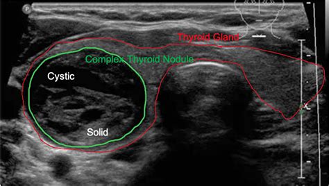 Thyroid Cyst Ultrasound