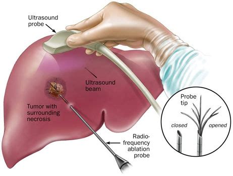 Liver Tumor Treatment, Transarterial chemoembolization, Transarterial Radioembolization ( Tare )