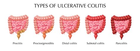 What is Pancolitis? Symptoms, Causes & Treatment