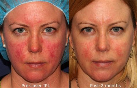 IPL Photofacial Treatments by San Diego Dermatology Experts