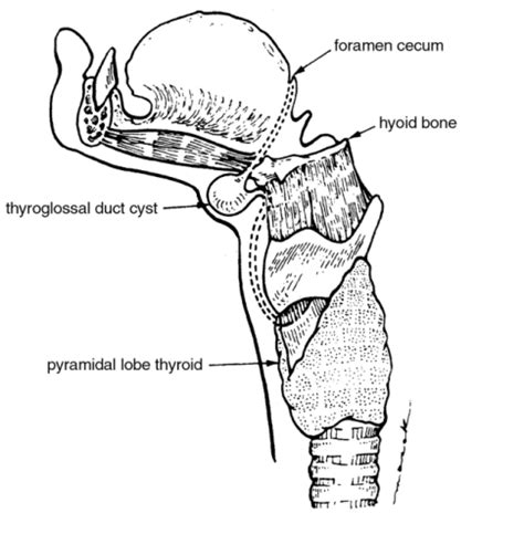 Thyroglossal Duct Cyst Surgery Sistrunk Procedure - ENT Clinic Sydney