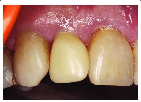 Temporary restoration shortly before removal. | Download Scientific Diagram