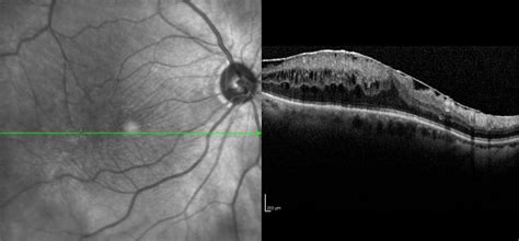 Epi-Retinal Membrane (ERM) - Dr Rehman Siddiqui