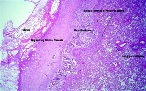 Pleural Anatomy and Fluid Analysis | Radiology Key