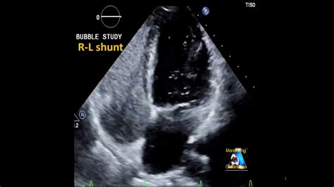 Bubble test (agitated saline) positive: L-R shunt #shorts - YouTube