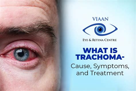 What is Trachoma | Causes, Symptooms, and Treatment