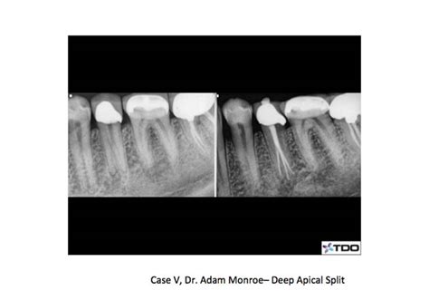 Root Canal Anatomy - Mandibular BicuspidTri-City Dev