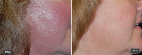 Laser Genesis Skin Tone & Scar Removal Before After Photos Beverly ...