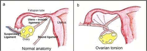 Ovarian torsion - MEDizzy