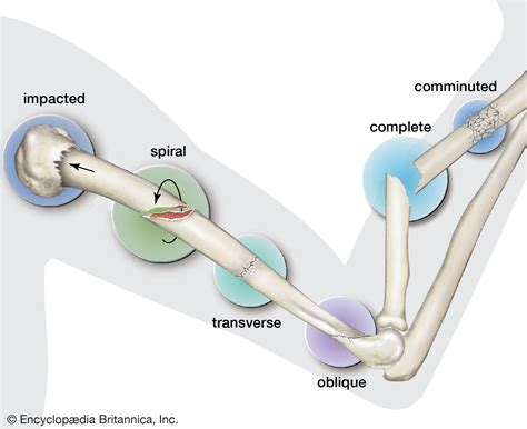 Fracture | Types, Causes & Symptoms | Britannica