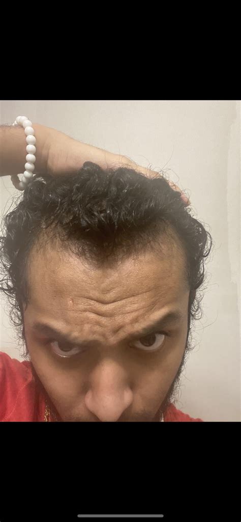 Maturing Hairline or Receding Hairline? : r/malepatternbaldness