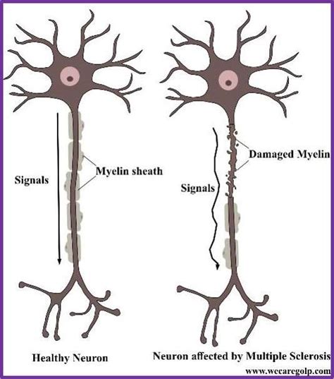 Multiple Sclerosis (MS): Types, Symptoms, Treatment - We Care