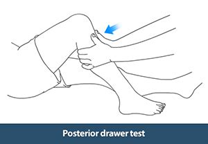 Top 80 of Posterior Drawer Test Knee | luiscadenillas2007