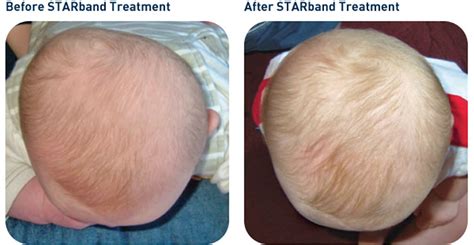 Before and After Photos | Cranial Center