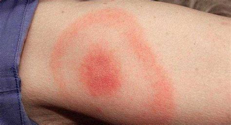 Lyme Disease: Cause, Symptoms, Treatments and other Remedies