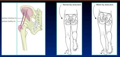 waddling gait / myopathic gait / gait training / myopathic gait ...