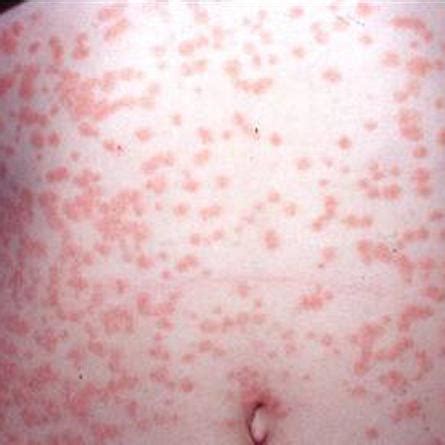 Free For Health: Guttate Psoriasis Causes and Symptoms