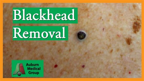 Giant Blackheads Removal