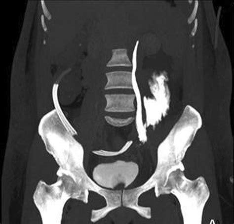 A. CT-urogram of a left ureteral injury lesion after a hysterectomy ...