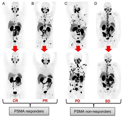 PSMA-PET predicts patient response to chemotherapy