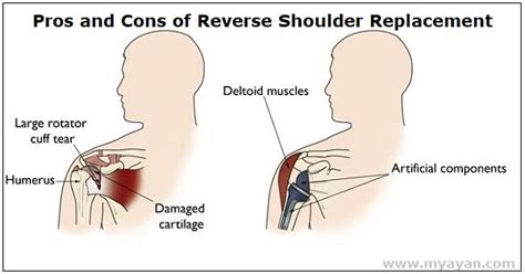 Pros and Cons of Reverse Shoulder Replacement Surgery