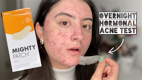 OVERNIGHT HERO MIGHTY CHIN PATCH TEST ON BLEMISHES - YouTube