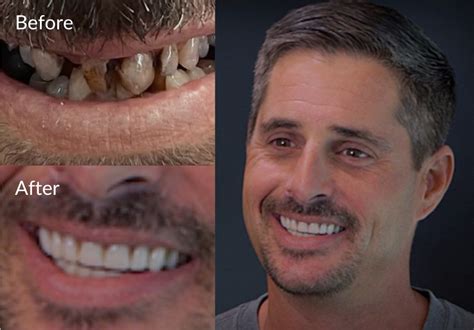 Snap-In Implant Dentures Transform Quality of Eating For Arizona Man | ProSmile