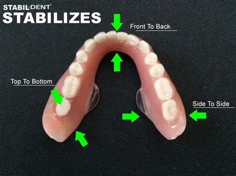 14 best dentures fitting less sorez images on Pinterest | Dental ...