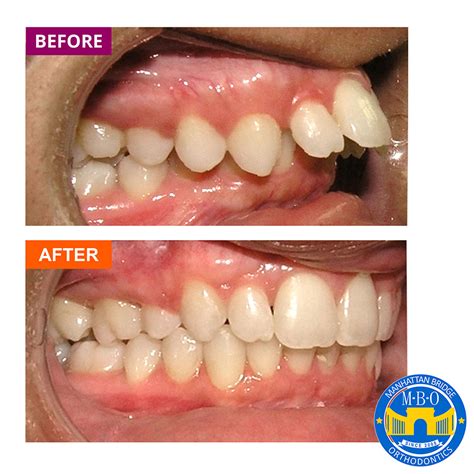 Overbite - Manhattan Bridge Orthodontics