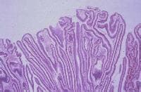 medicine in medicine: Villous Adenoma